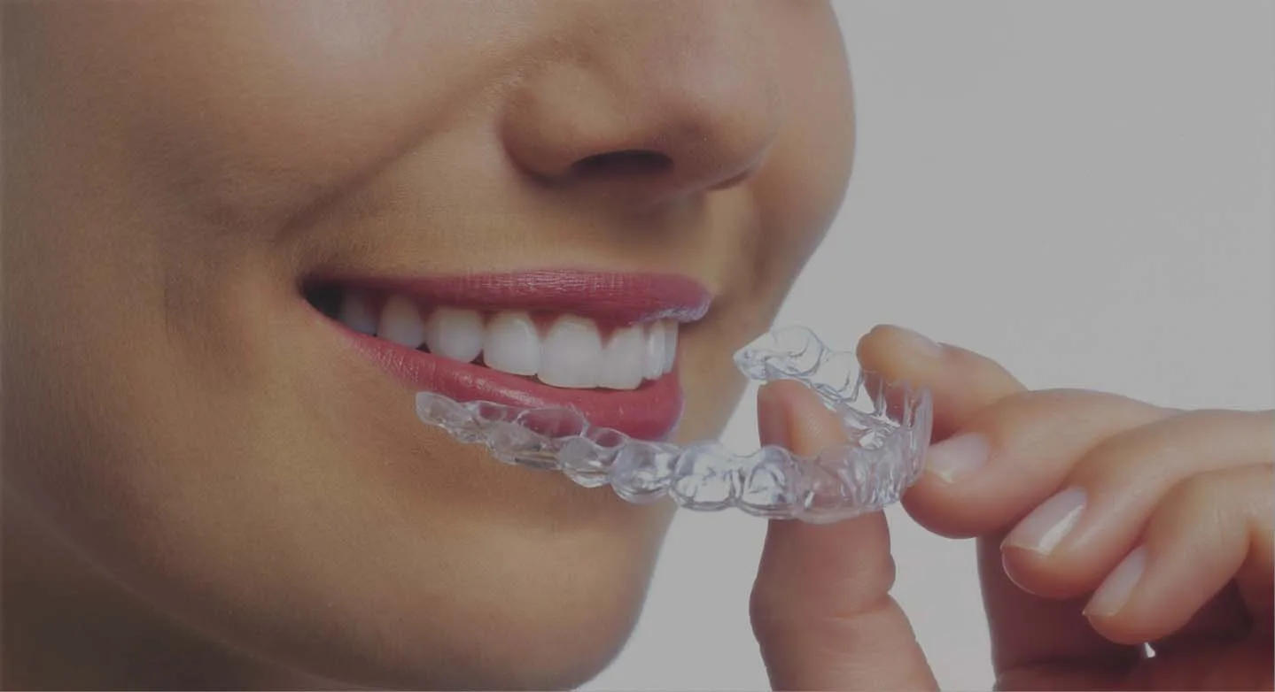 Patient placing a clear Invisalign aligner over her teeth
